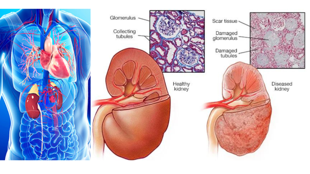 Chronic Kidney Disease