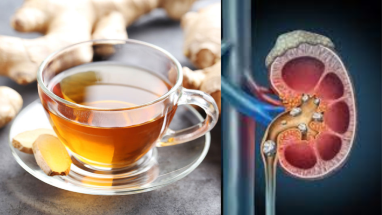 Ginger Tea Magic for kidney stone